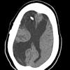 1A Meningitis, 13 mo, survive 22 yr (Case 1) CT 1 - Copy