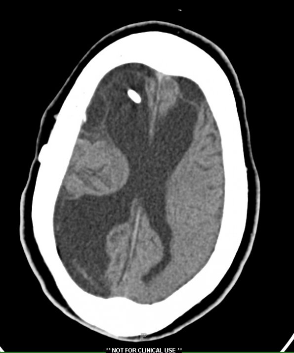 1A Meningitis, 13 mo, survive 22 yr (Case 1) CT 1 - Copy