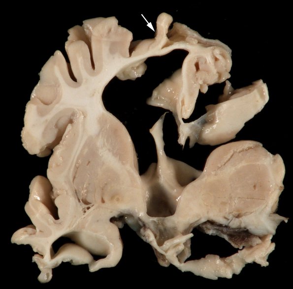 1B1 Meningitis, BStr, long survival (Case 1) Gross_11 copy