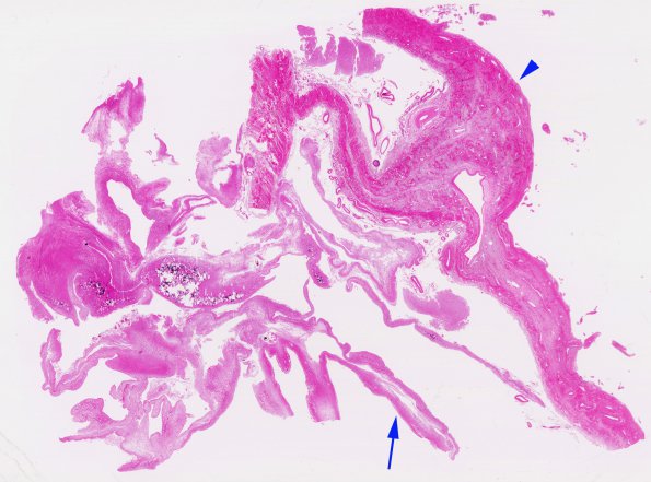 1C1 Meningitis, BStr, long survival (Case 1) H&E whole mount cortex-dura 4 copy