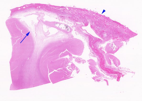 1C2 Meningitis, BStr, long survival (Case 1) H&E whole mount cortex-dura 3 copy