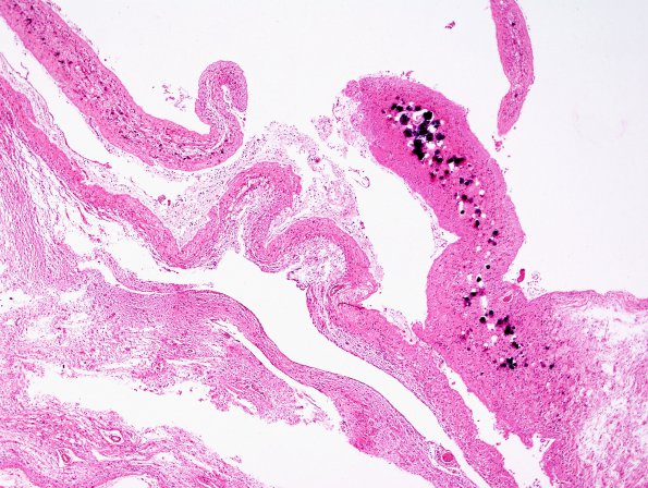 1C3 Meningitis, BStr, long survival (Case 1) H&E cortex 4