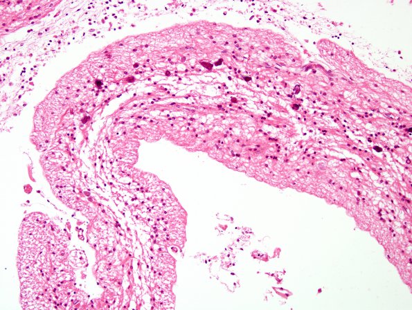 1C4 Meningitis, BStr, long survival (Case 1) H&E cortex 5