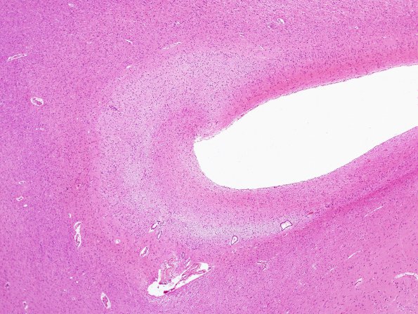 1C6 Meningitis, BStr, long survival (Case 1) periventricular gran ependymitis H&E 2