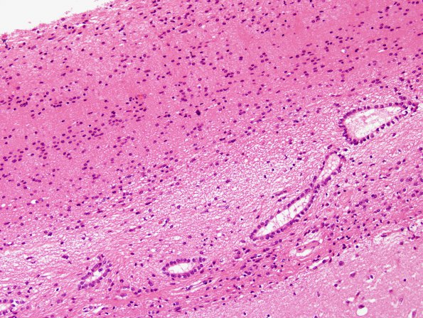 1C7 Meningitis, BStr, long survival (Case 1) periventricular gran ependymitis H&E 3