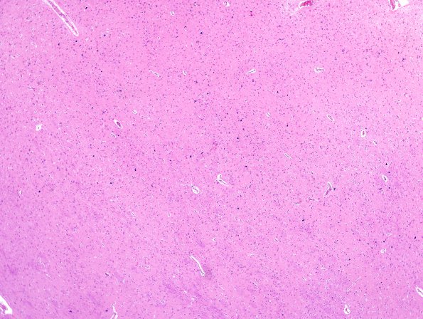 1C8 Meningitis, BStr, long survival (Case 1) thalamus mineralized neurons H&E 3