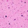 1C9 Meningitis, BStr, long survival (Case 1) thalamus mineralized neurons H&E 2