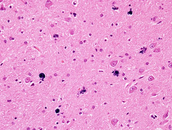 1C9 Meningitis, BStr, long survival (Case 1) thalamus mineralized neurons H&E 2