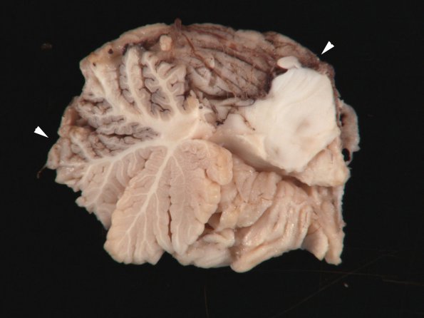 1D1 Meningitis, BStr, long survival (Case 1) Gross_17 copy