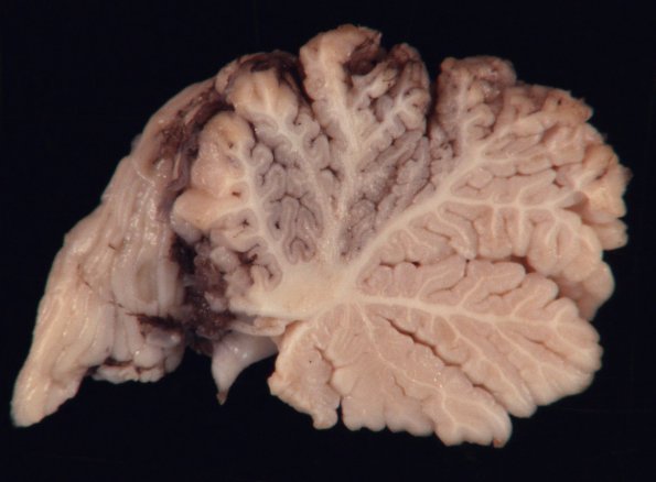 1D2 Meningitis, BStr, long survival (Case 1) Gross_19