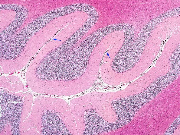 1E1 Meningitis, BStr, long survival (Case 1) H&E leptomeningeal melanocytes 8 copy