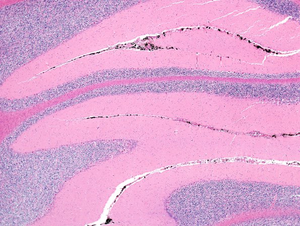 1E2 Meningitis, BStr, long survival (Case 1) H&E leptomeningeal melanocytes 11