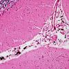 1E3 Meningitis, BStr, long survival (Case 1) H&E leptomeningeal melanocytes 9