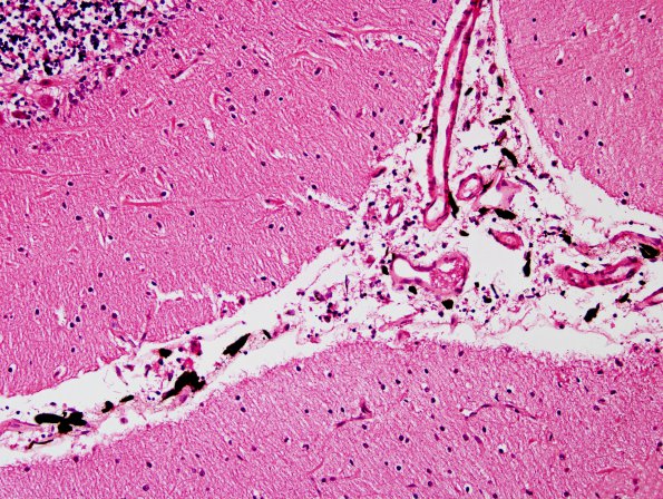 1E3 Meningitis, BStr, long survival (Case 1) H&E leptomeningeal melanocytes 9