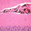 1E4 Meningitis, BStr, long survival (Case 1) H&E leptomeningeal melanocytes 12