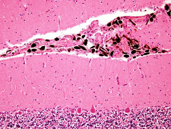 1E4 Meningitis, BStr, long survival (Case 1) H&E leptomeningeal melanocytes 12