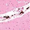 1E5 Meningitis, BStr, long survival (Case 1) H&E leptomeningeal melanocytes 10