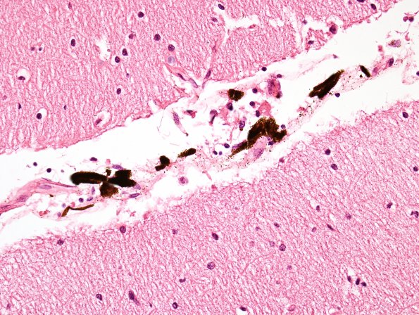 1E5 Meningitis, BStr, long survival (Case 1) H&E leptomeningeal melanocytes 10