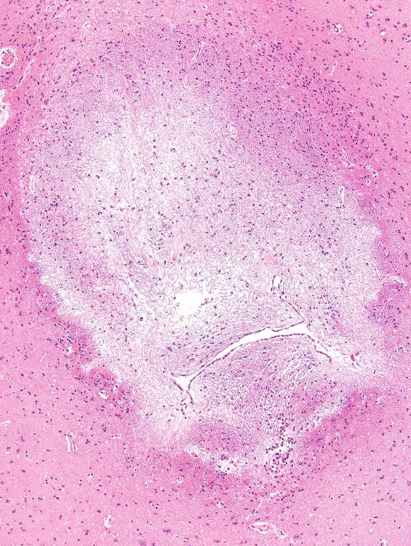 1F2 Meningitis, BStr, long survival (Case 1) H&E aqueductal gliosis 6