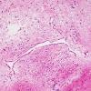 1F3 Meningitis, BStr, long survival (Case 1) H&E aqueductal gliosis 7