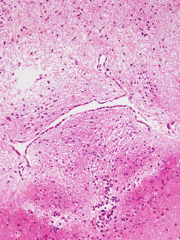 1F3 Meningitis, BStr, long survival (Case 1) H&E aqueductal gliosis 7