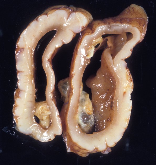 3A3 Ventriculitis, IVH, HC, obstructed acqueduct, Klebsiella (Case 3) 2