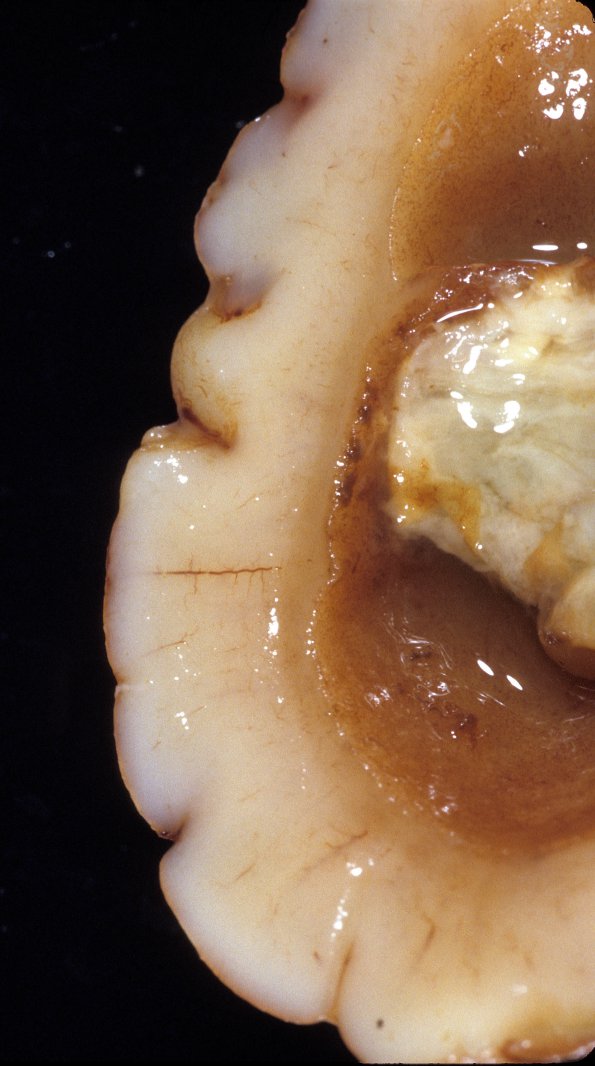 3A4 Ventriculitis, IVH, HC, obstructed aqueduct, Klebsiella (Case 3) 3