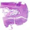 3B1 Ventriculitis, IVH, HC, obstructed aqueduct, Klebsiella (Case 3) N5 copy copy