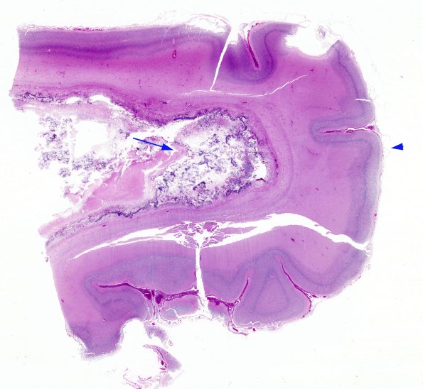 3B1 Ventriculitis, IVH, HC, obstructed aqueduct, Klebsiella (Case 3) N5 copy copy