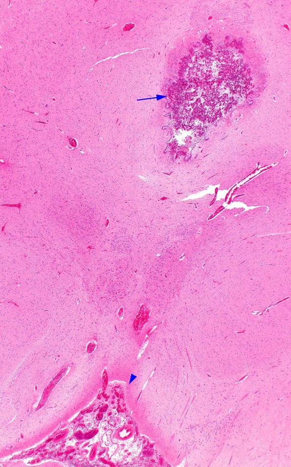 3B2 Ventriculitis, IVH, HC, obstructed aqueduct, Klebsiella (Case 3) N6 H&E copy