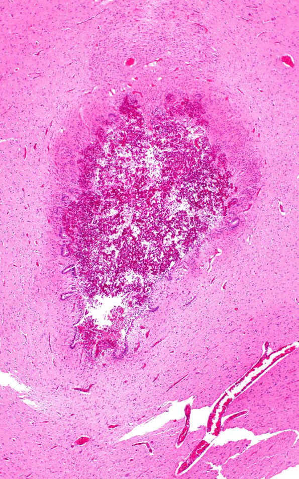 3B3 Ventriculitis, IVH, HC, obstructed aqueduct, Klebsiella (Case 3) N6 H&E 3