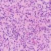 1A1 Atypical Mycobacteria (Case 1) H&E 8