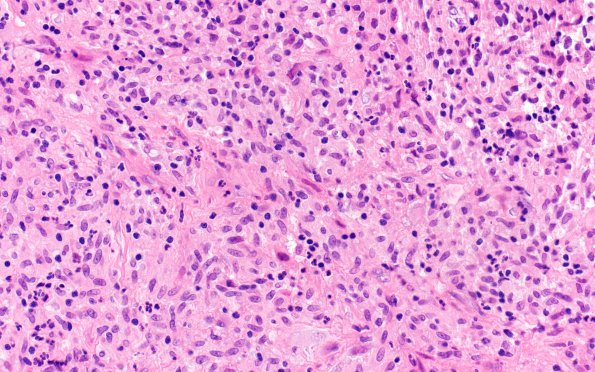 1A2 Atypical Mycobacteria (Case 1) H&E 3