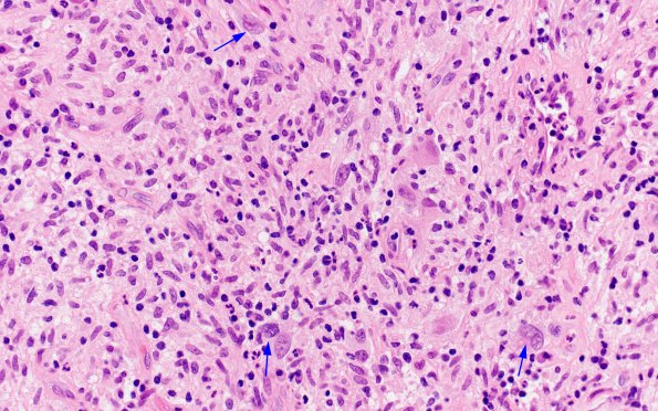 1A3 Atypical Mycobacteria (Case 1) H&E 10 copy