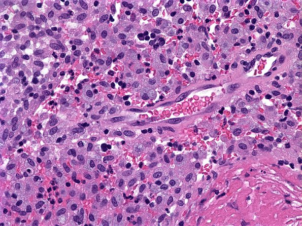 1A5 Atypical Mycobacteria (Case 1) 2