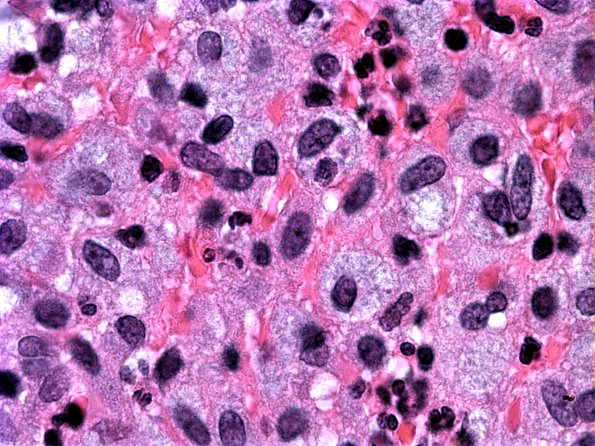 1A6 Atypical Mycobacteria (Case 1) 1