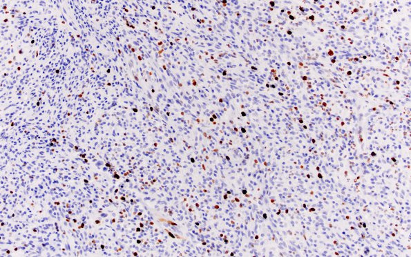 1B1 Atypical Mycobacteria (Case 1) Ki67 1