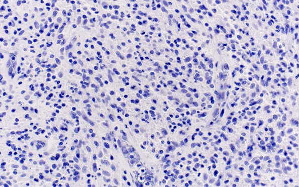 1B2 Atypical Mycobacteria (Case 1) CK 1