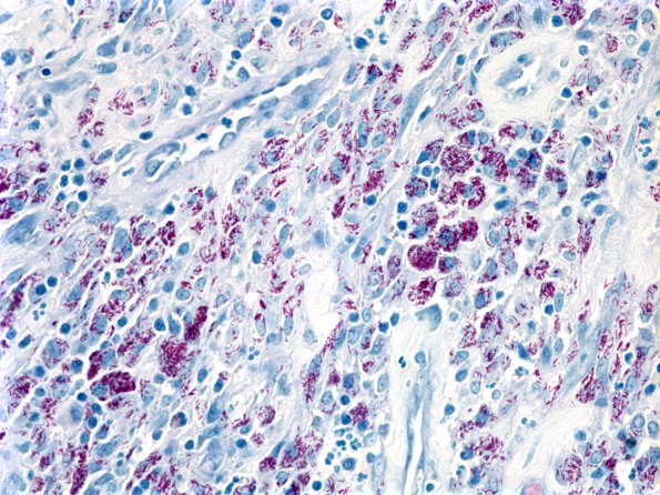 1C1 Atypical Mycobacteria (Case 1) AFB aA