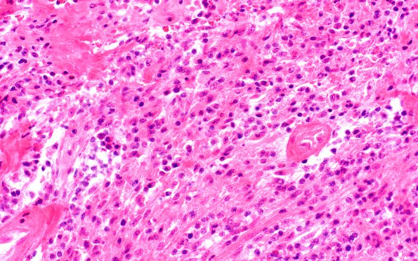 1C2 Atypical Mycobacteria (Case 1) area A H&E 40X