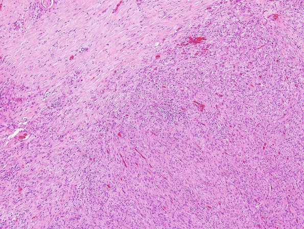 2A1 Mycobacterium, atypical MAI (AANP1998, Case 3) H&E 20X 3