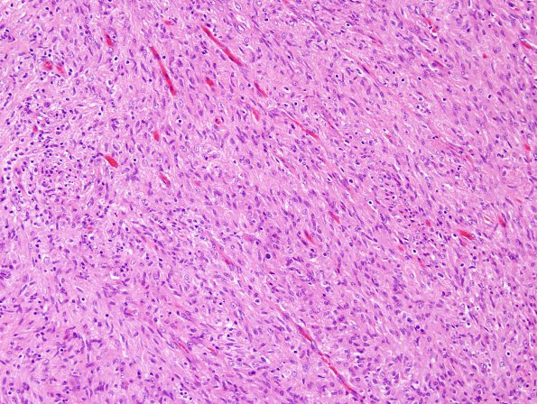 2A2 Mycobacterium, atypical MAI (AANP1998, Case 3) H&E 20X 1