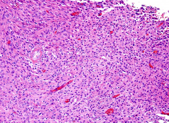 2A3 Mycobacterium, atypical MAI (AANP1998, Case 3) H&E 20X 2