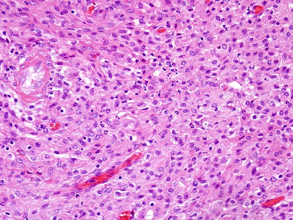 2A4 Mycobacterium, atypical MAI (AANP1998, Case 3) H&E 40X 1