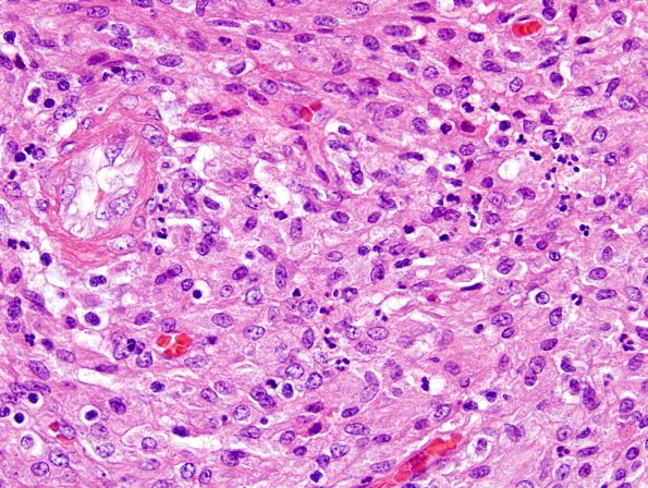 2A6 Mycobacterium, atypical MAI (AANP1998, Case 3) H&E 60X 2