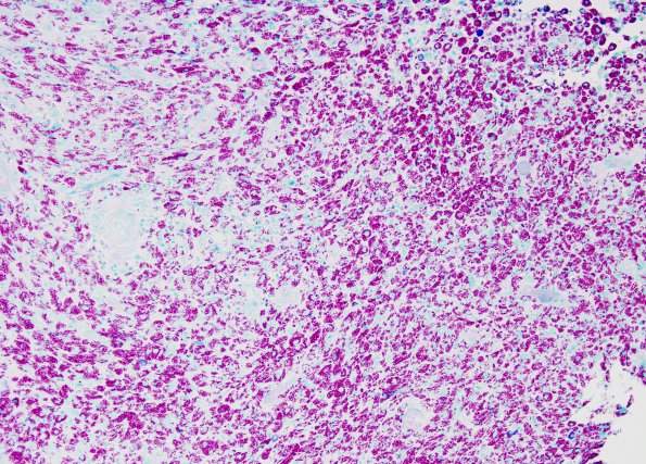 2B1 Mycobacterium, atypical MAI (AANP1998, Case 3) AFB 20X