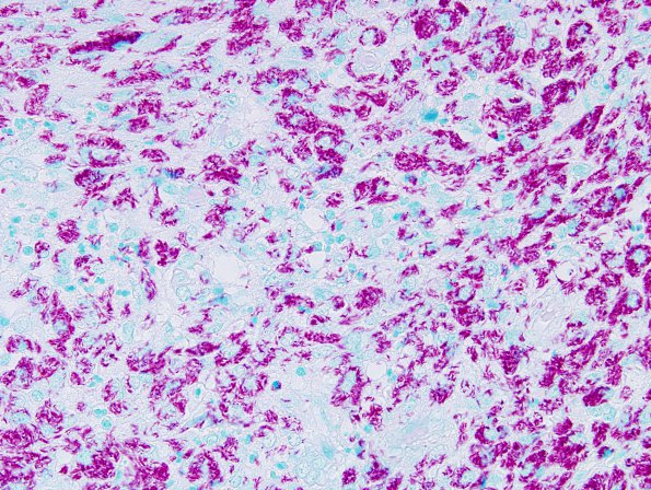 2B2 Mycobacterium, atypical MAI (AANP1998, Case 3) AFB 60X 1