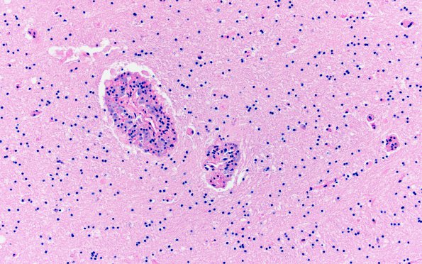 3A1 Mycobacterium, atypical MAI (AANP1995, Case 6) H&E 3