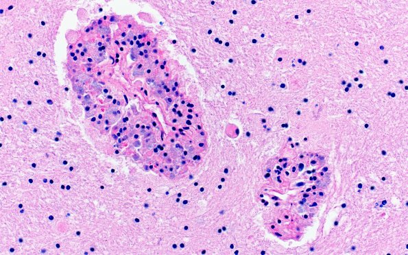 3A2 Mycobacterium, atypical MAI (AANP1995, Case 6) H&E 4