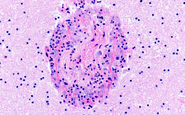 3A3 Mycobacterium, atypical MAI (AANP1995, Case 6) H&E 5